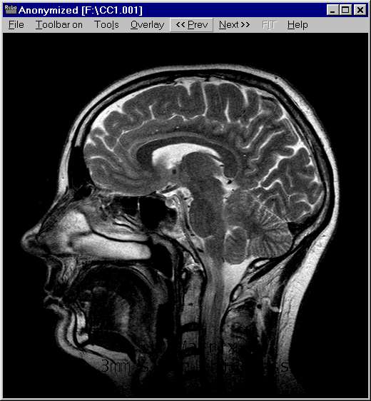 mri brain scan. Image 08: MR image